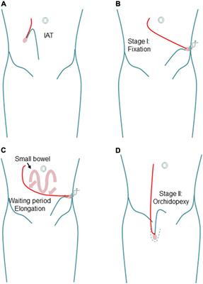 Open controversies on the treatment of undescended testis: An update